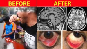 HE ATE STREET FOOD IN INDIA 🪱 44 DAYS LATER, HIS BRAIN HAD WORMS