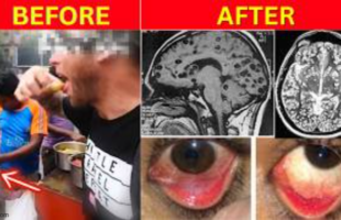 HE ATE STREET FOOD IN INDIA 🪱 44 DAYS LATER, HIS BRAIN HAD WORMS